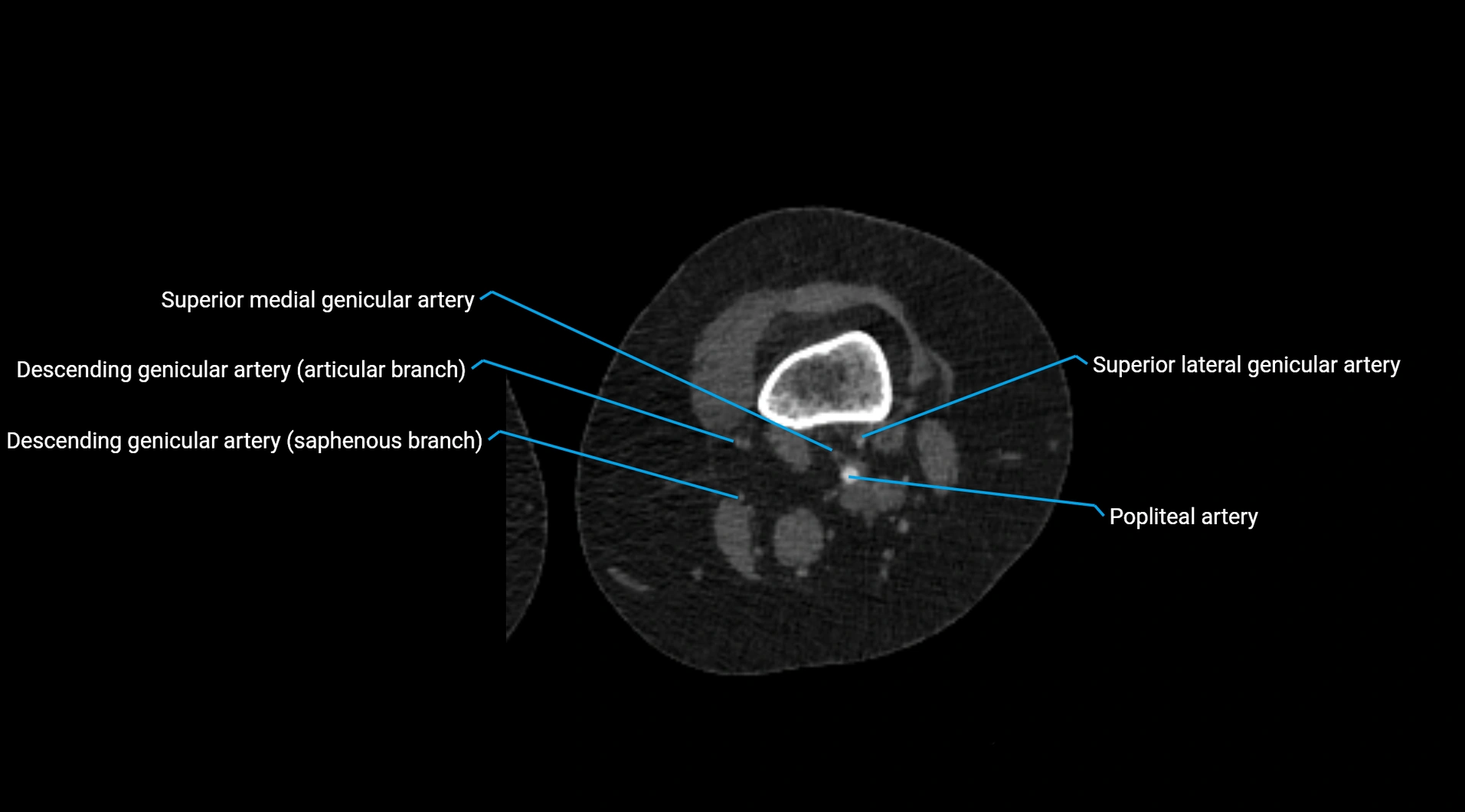 CTA lower limb cross sectional anatomy labelled image _165.webp